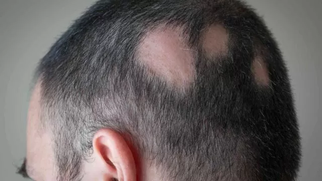 5 Best Alopecia Areata Natural Treatment Options That Work