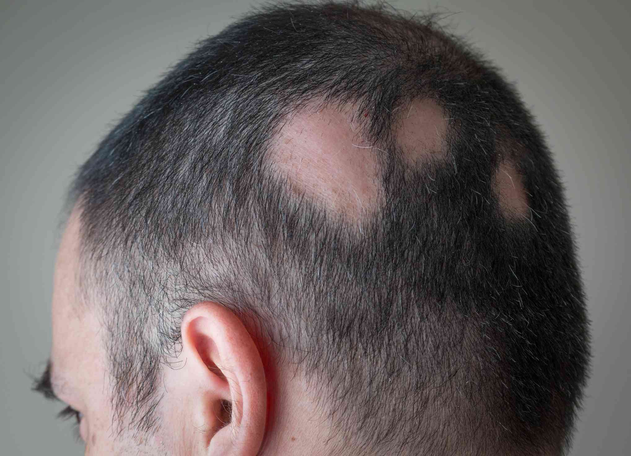 5 Best Alopecia Areata Natural Treatment Options That Work