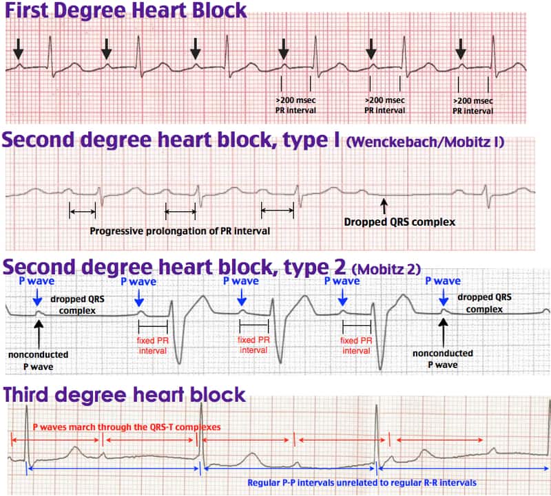 third second heartblocks cardiology