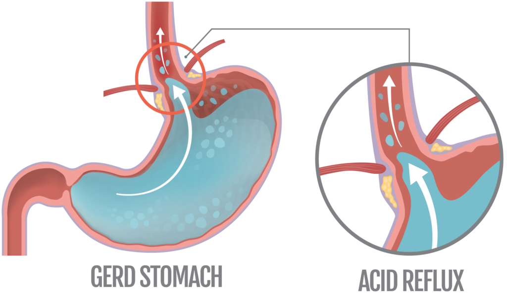 Stomach Acidity, Ulcers, and Reflux Heartburn Explained