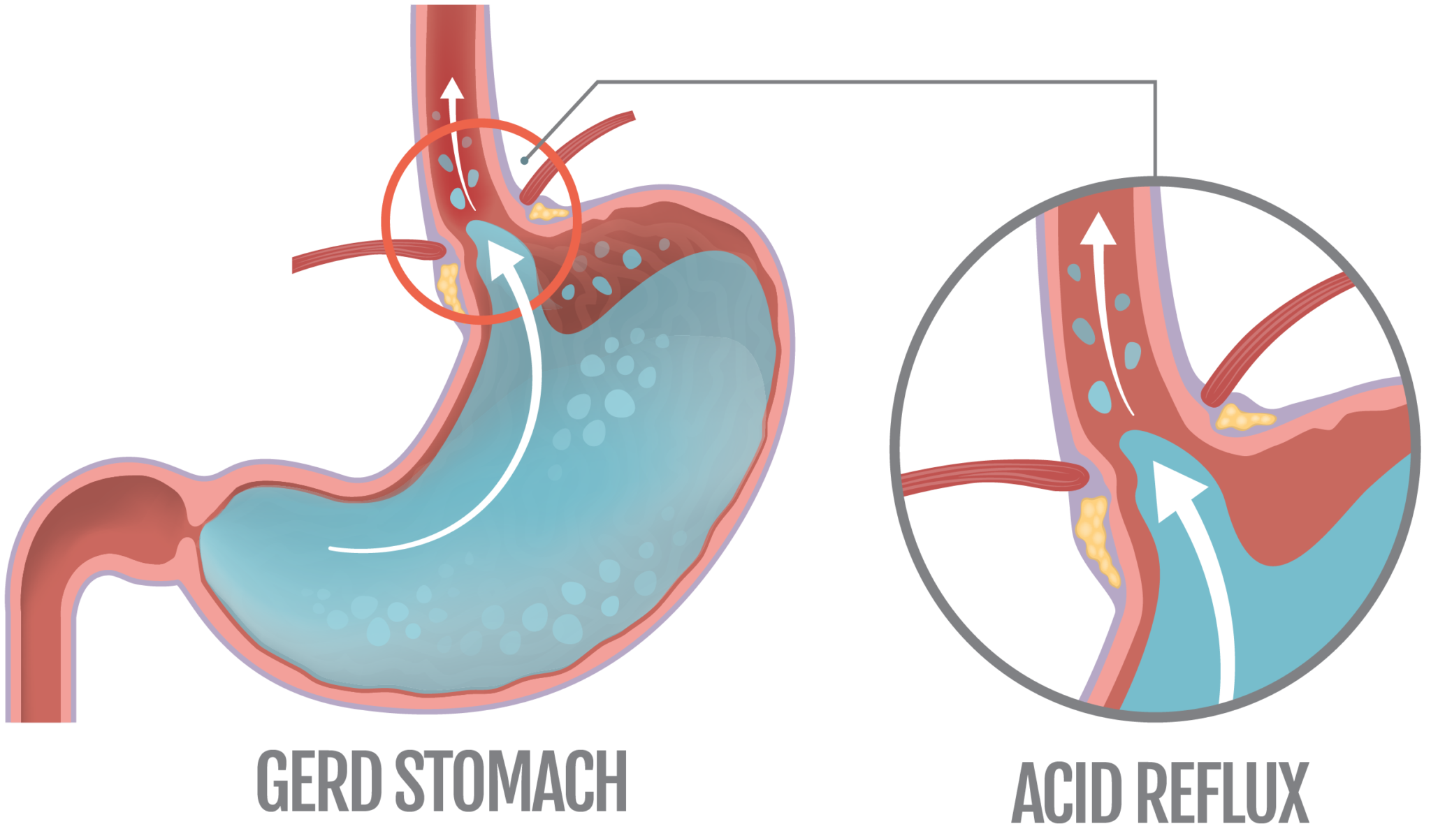 Stomach Acidity, Ulcers, and Reflux Heartburn Explained