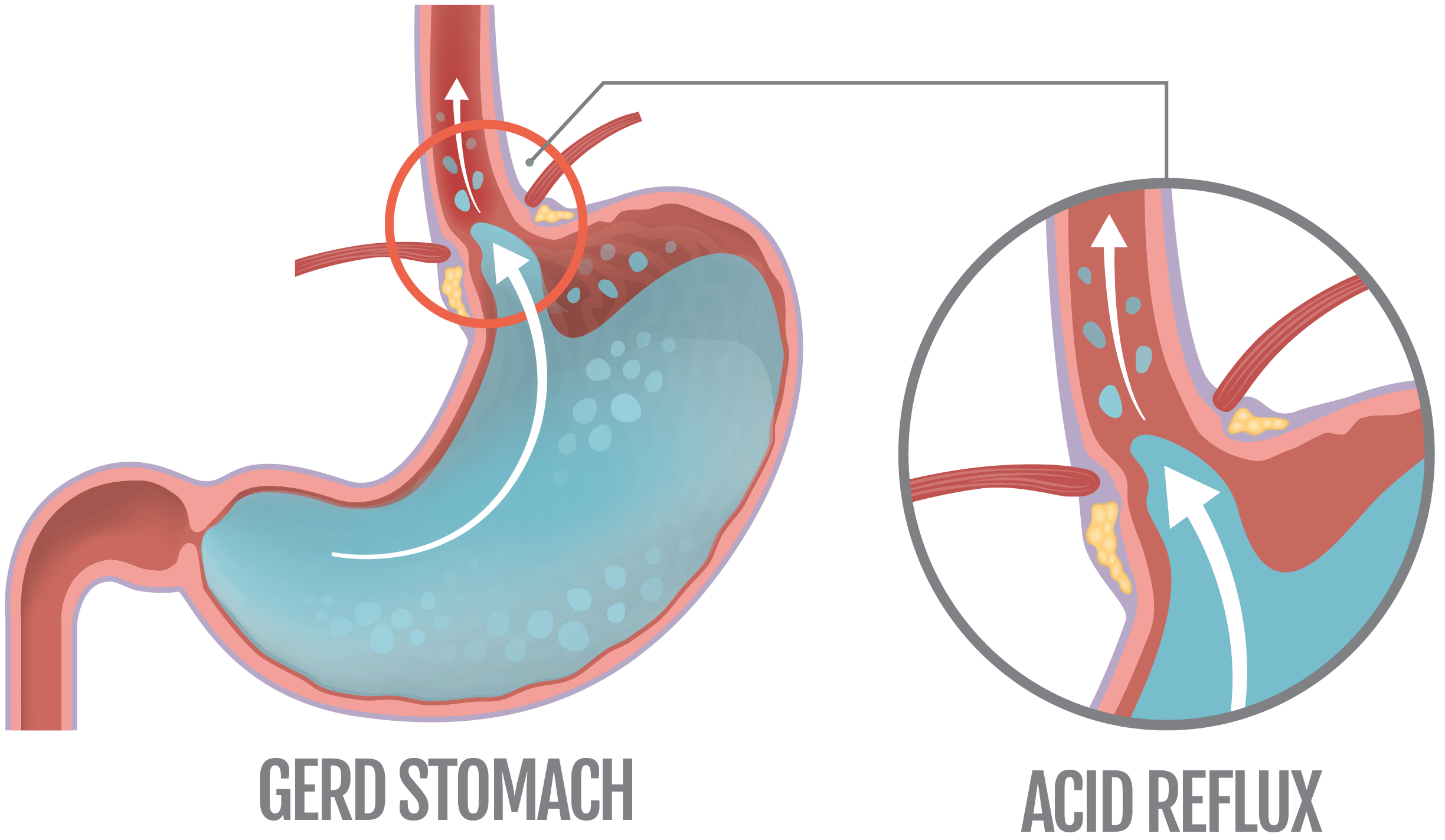 Acid Reflux and GERD stomach