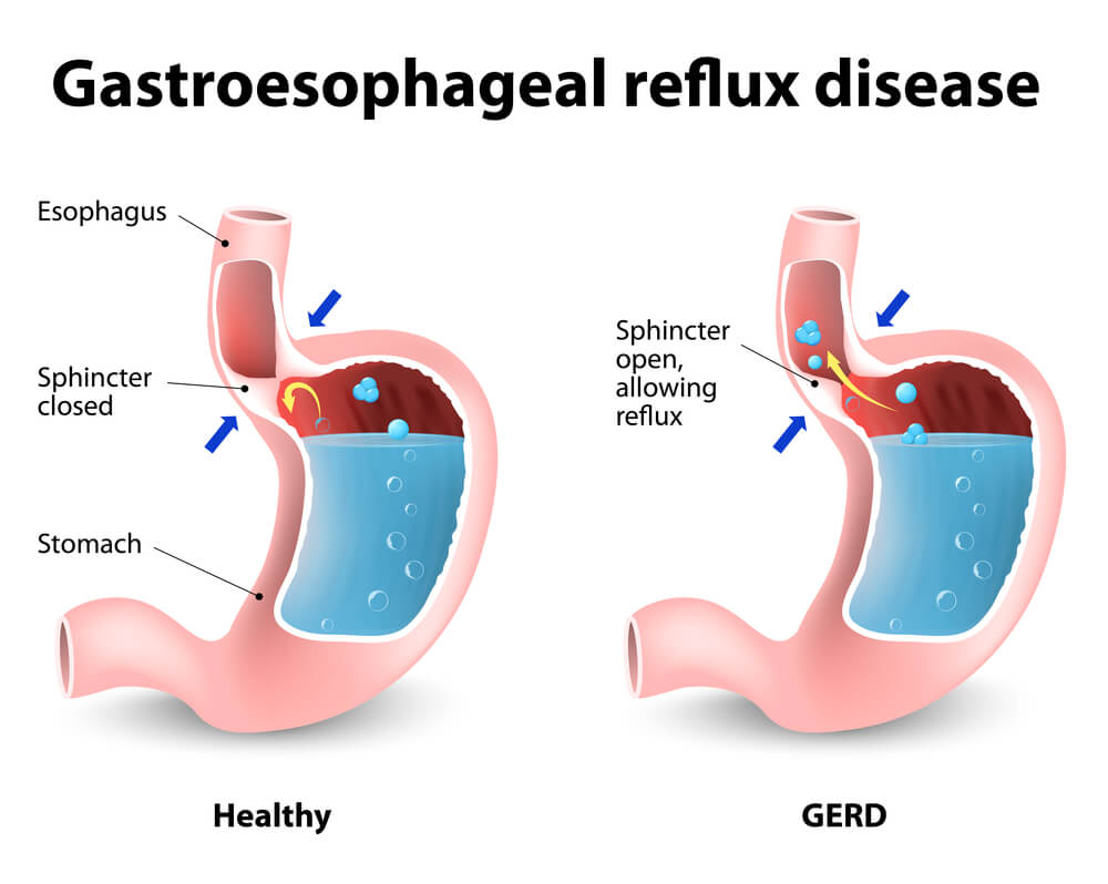 GERD Gastroesophageal Reflux Disease NaturalLivingTips