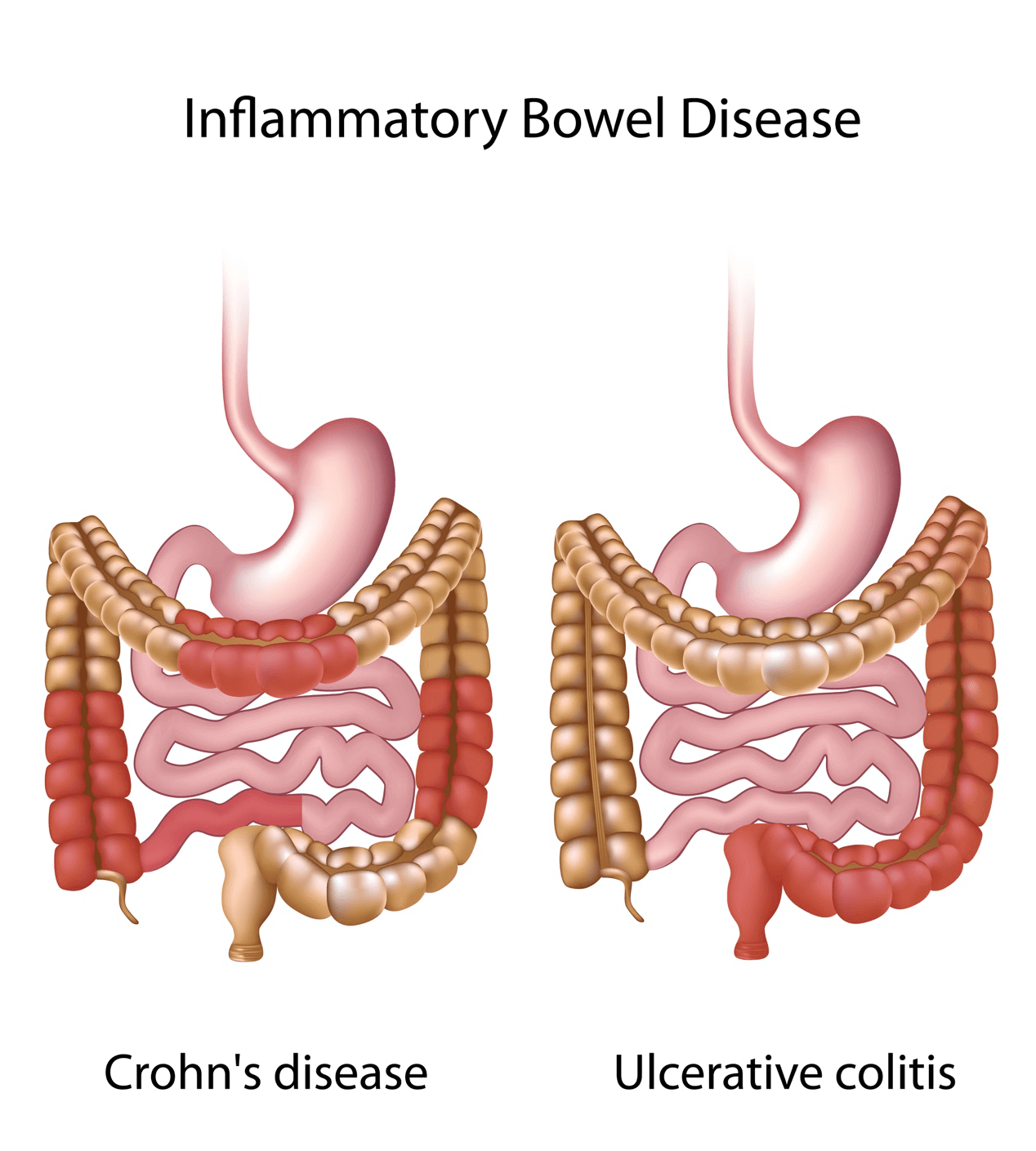 Inflammatory Bowel Diseases IBD Crohns Disease and Ulcerative Colitis