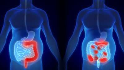 Inflammatory Bowel Diseases (IBD) Types and Causes Explained