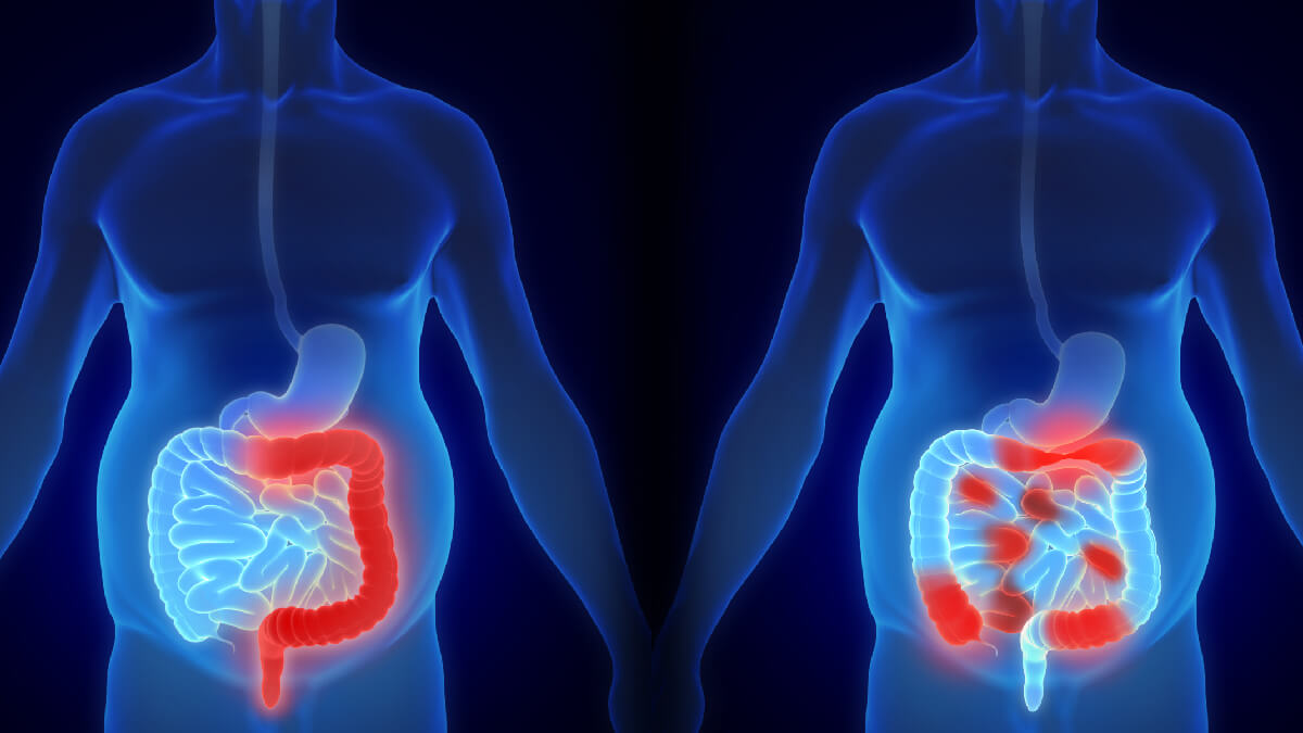 Inflammatory Bowel Diseases IBD Types and Causes Explained
