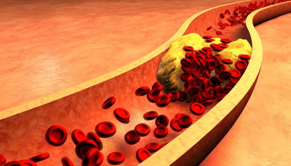 cholesterol plaque formation
