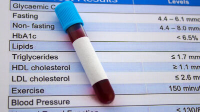 Is Cholesterol a Lipid or Steroid? Understanding Differences