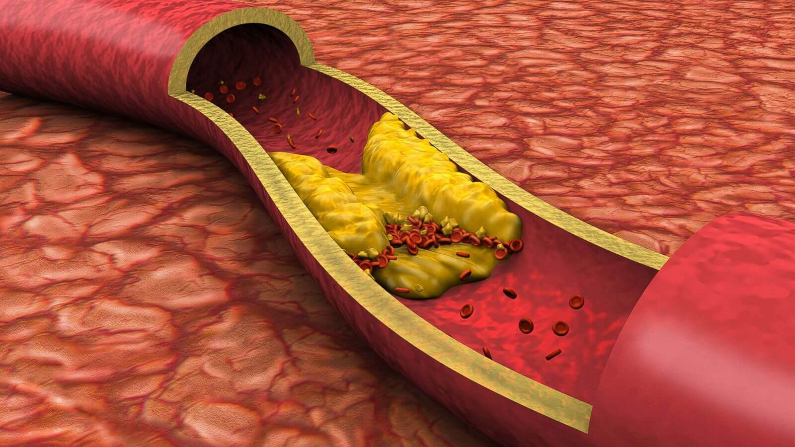 Understanding Cholesterol Levels LDL and HDL Levels Impact
