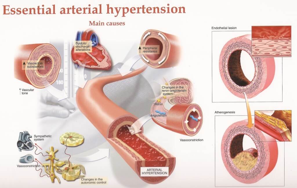 Essential Arterial hypertension Healthyious