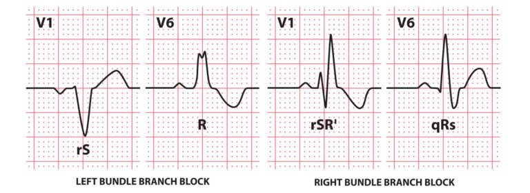 Bundle Branch Block: What is it? Causes, Symptoms, Treatment