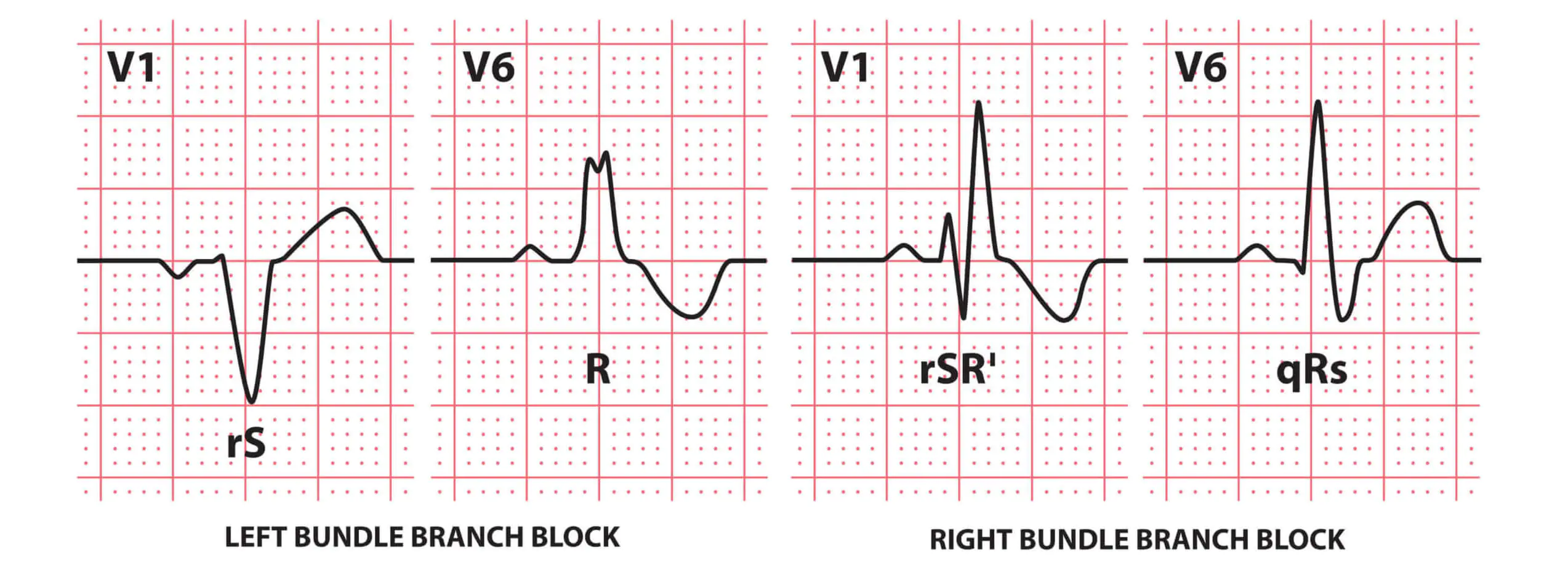 Bundle Branch Blocks