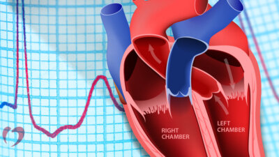 Heart Block: Types, Causes, Symptoms, Risks, Treatment
