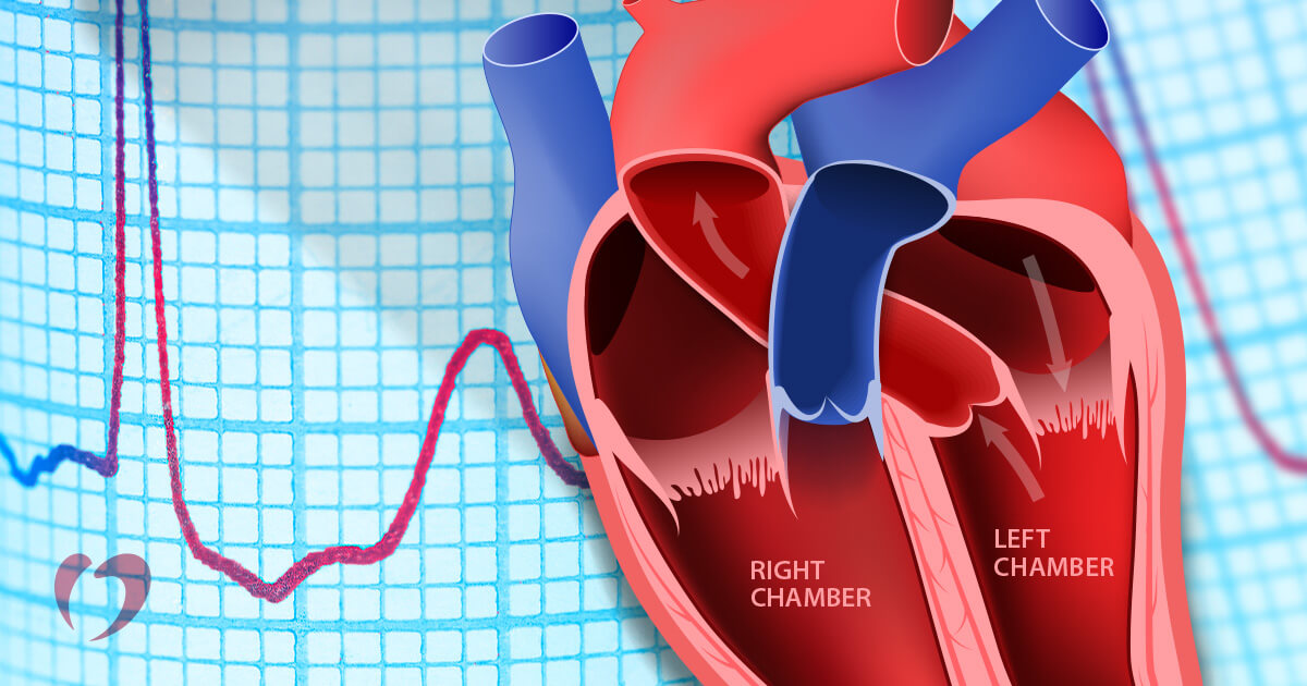 Heart Block Types Causes Symptoms Risks Treatment