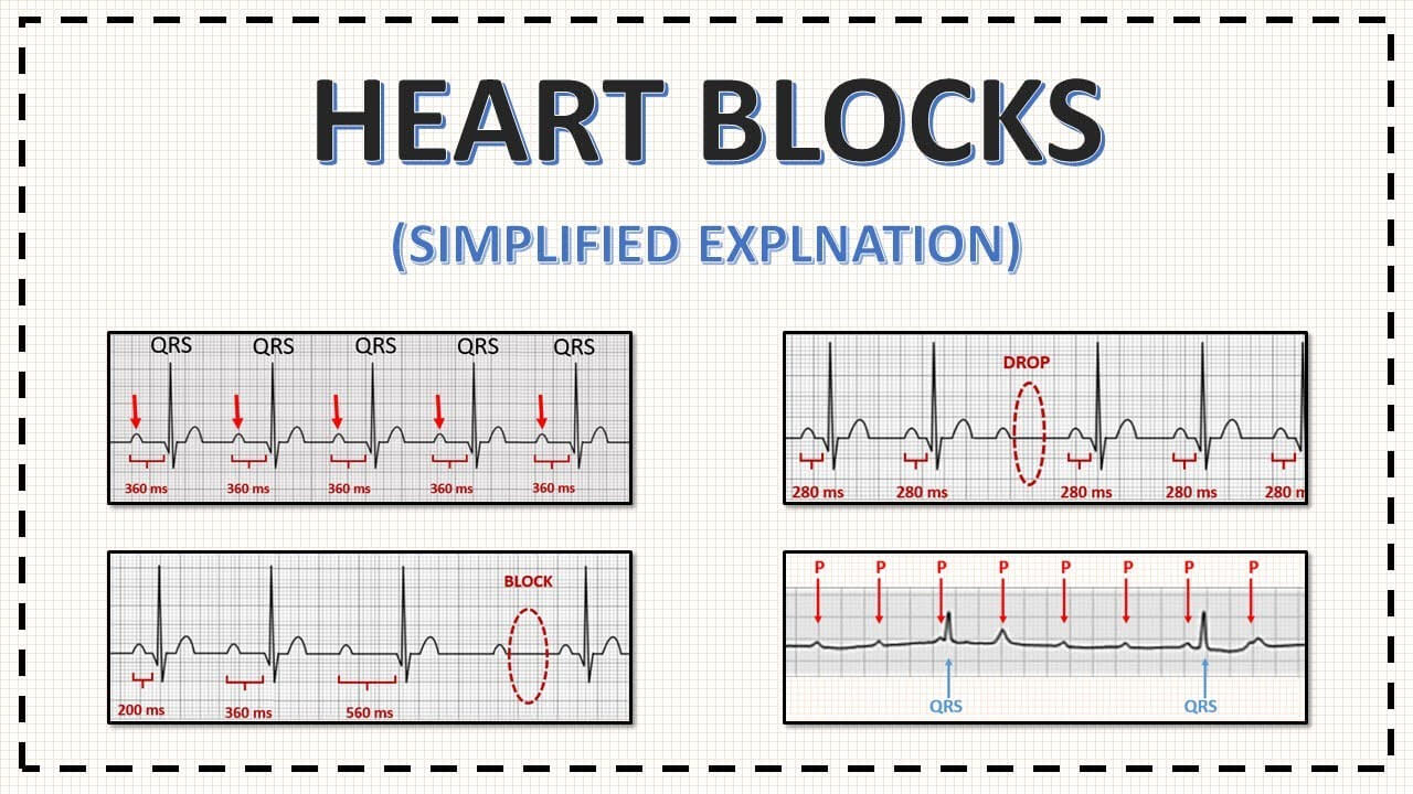 Heart Block simple explanation