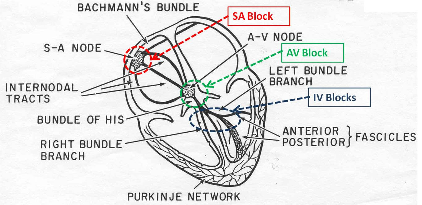Heart block Conduction diagram