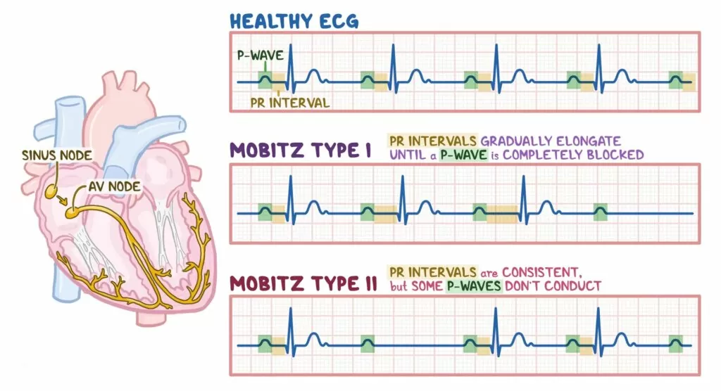 Second Degree Heart Block How Heart Starts Skipping Beats