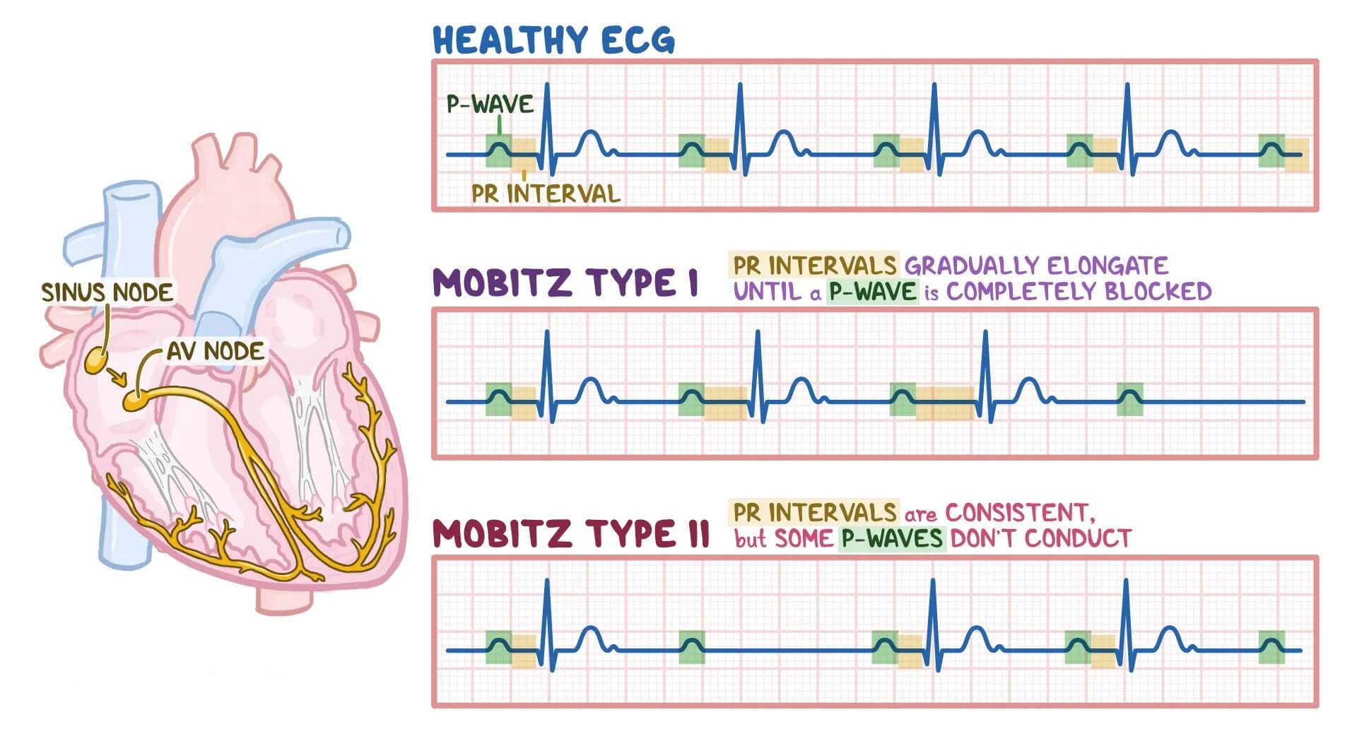 Second Degree Heart Block Types