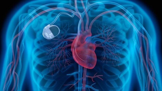 Sinoatrial Node Dysfunction (SND) Causes, Symptoms, Treatment