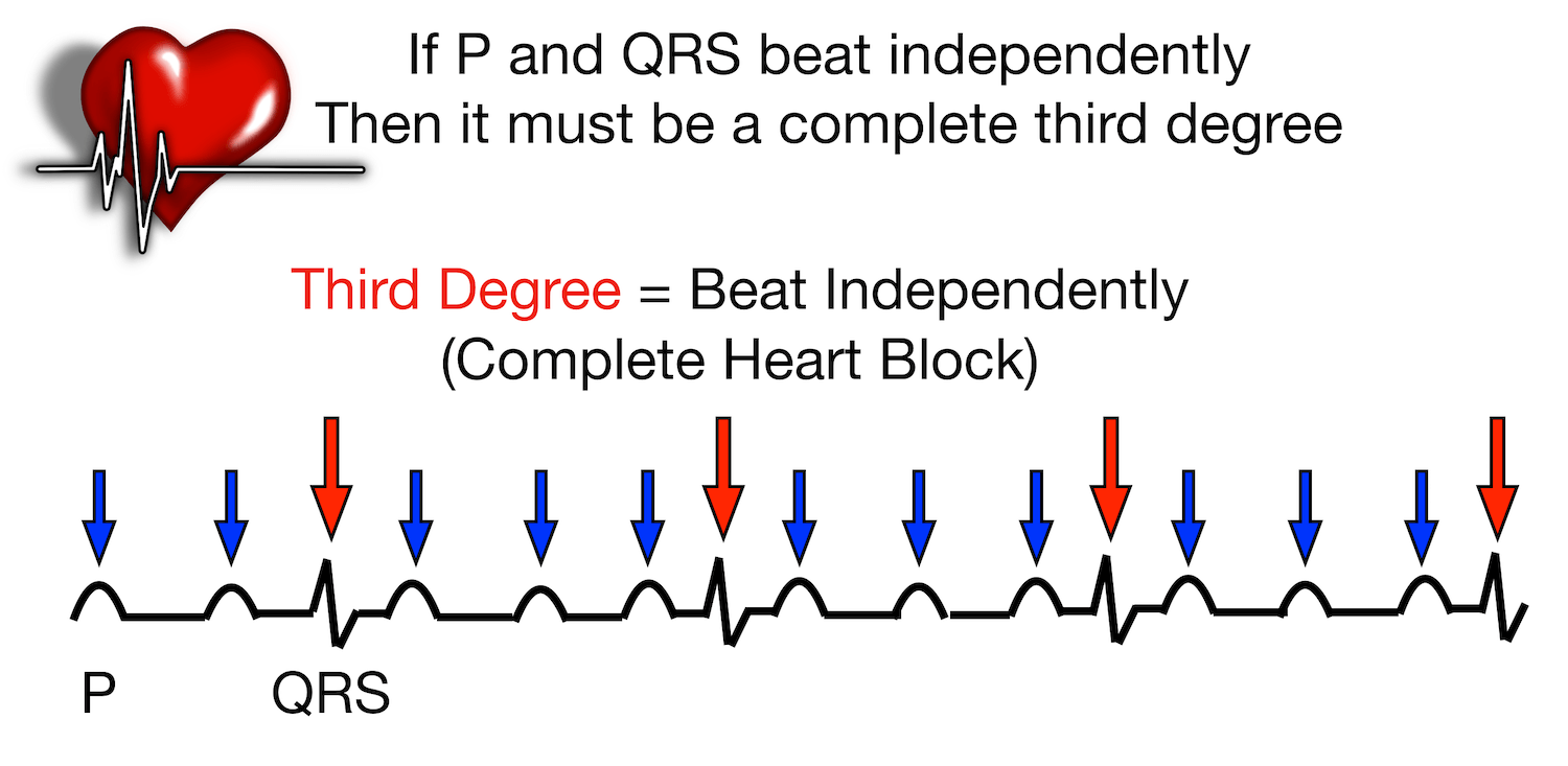 third degree heart block