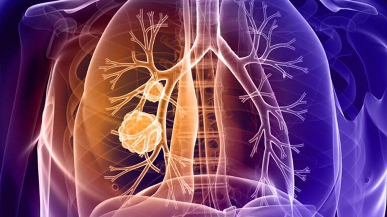 Emphysema Causes, Symptoms, Diagnosis, Treatment