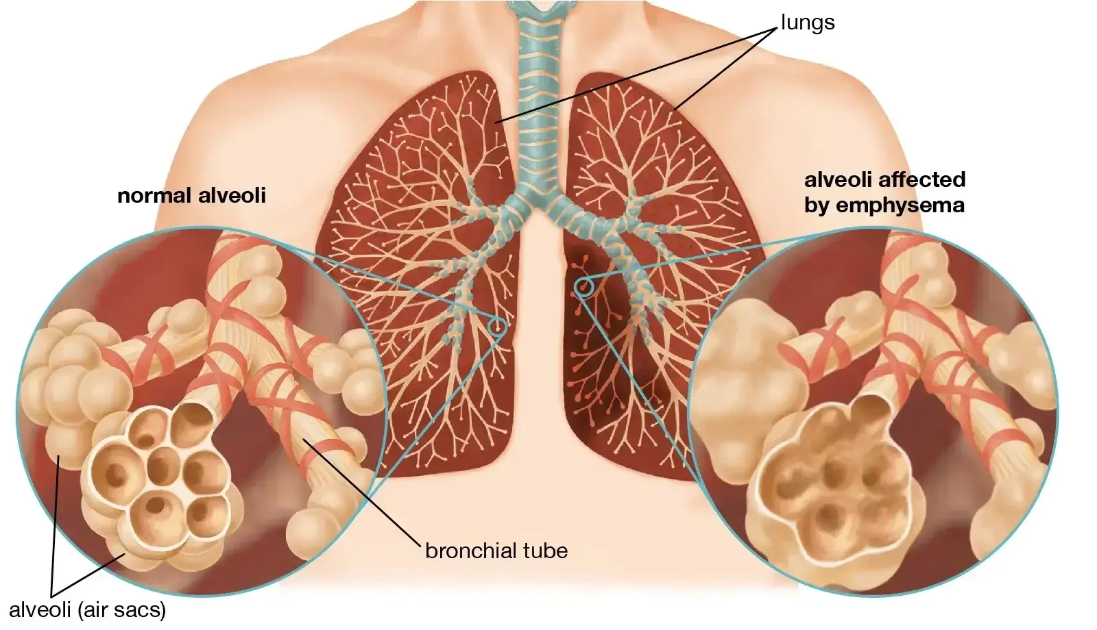 Emphysema Causes