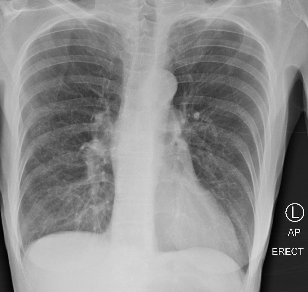 Emphysema Chest X ray