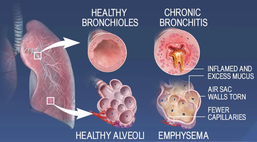 Emphysema Causes, Symptoms, Diagnosis, Treatment