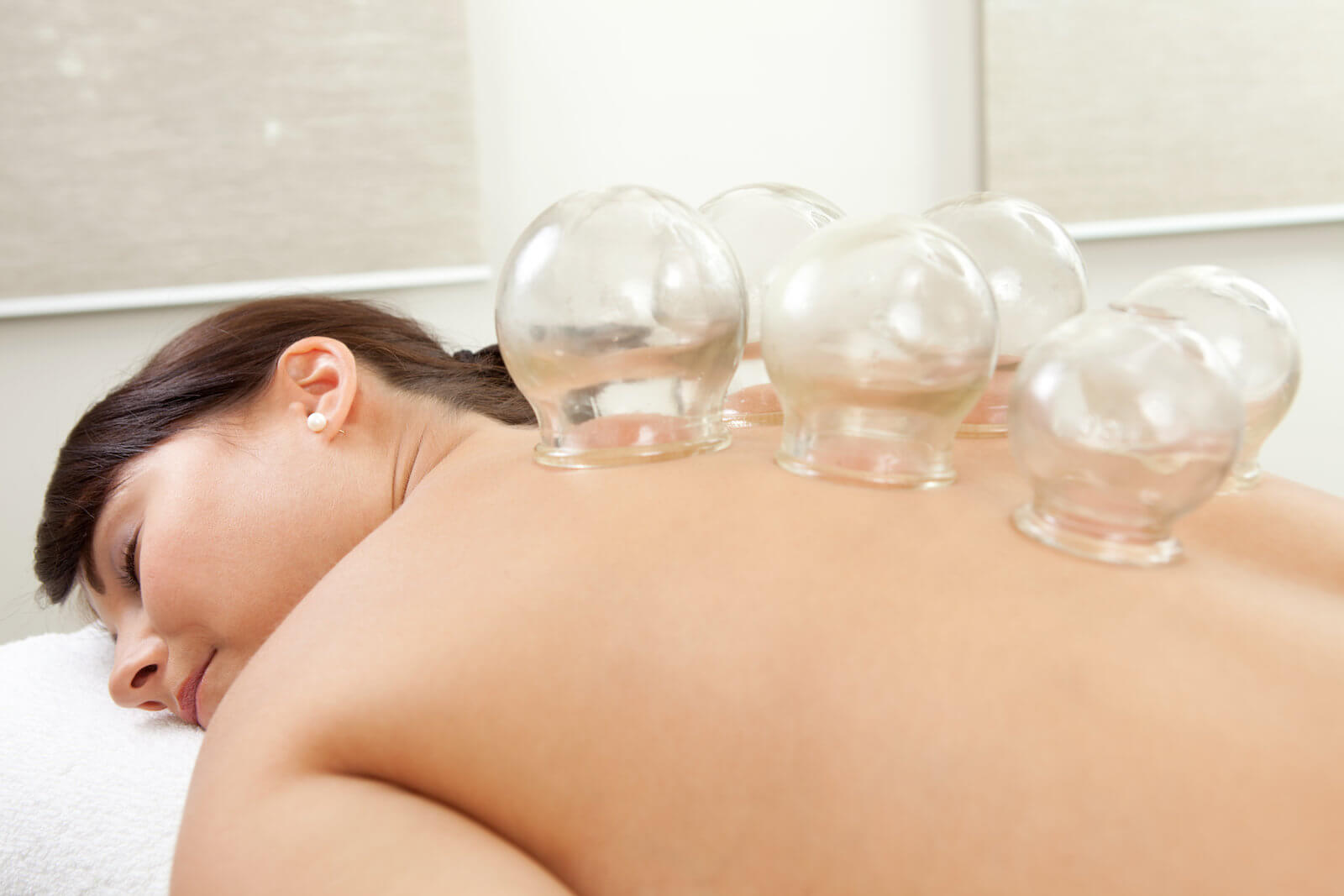 Migraine Headache acupuncture cupping treatment