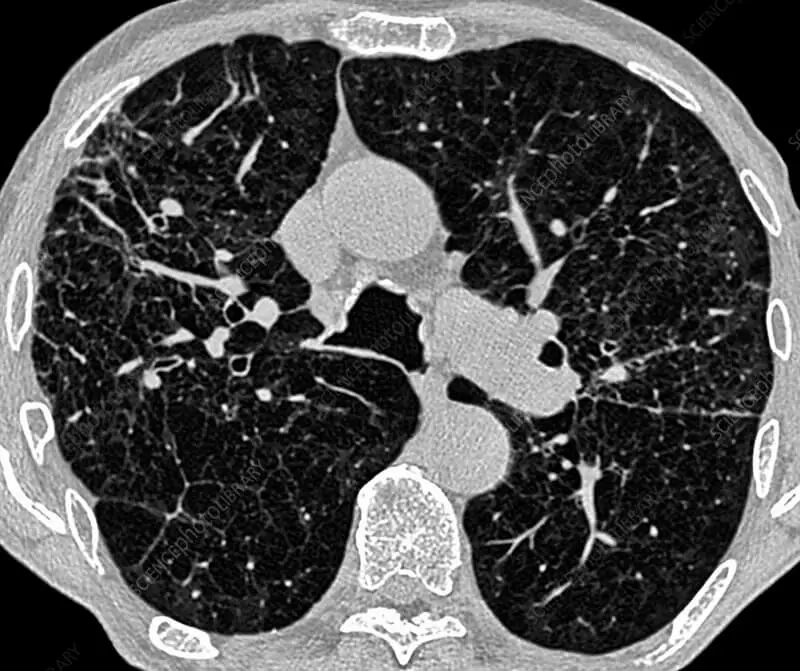 emphysema ct scan