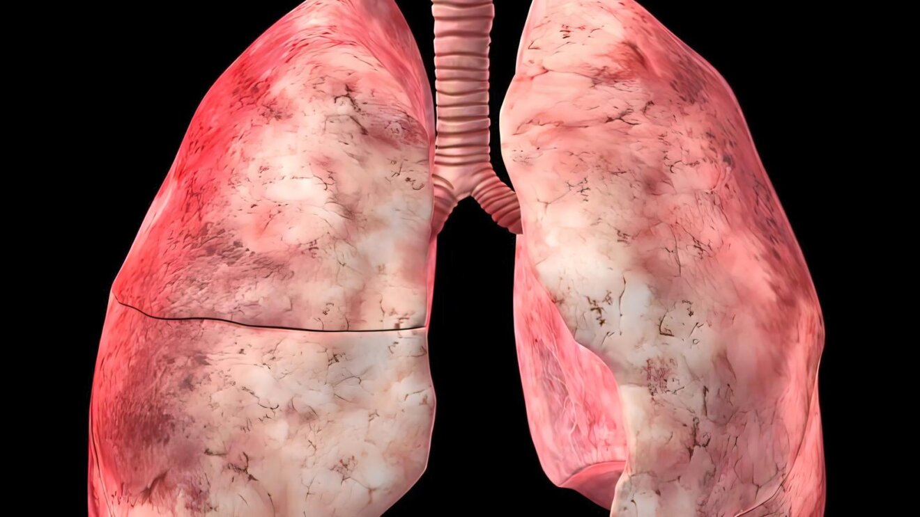 Bronchitis Causes, Symptoms, Diagnosis, Treatment Explained