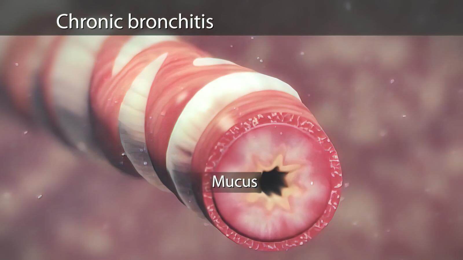 Causes and risk factor for Bronchitis