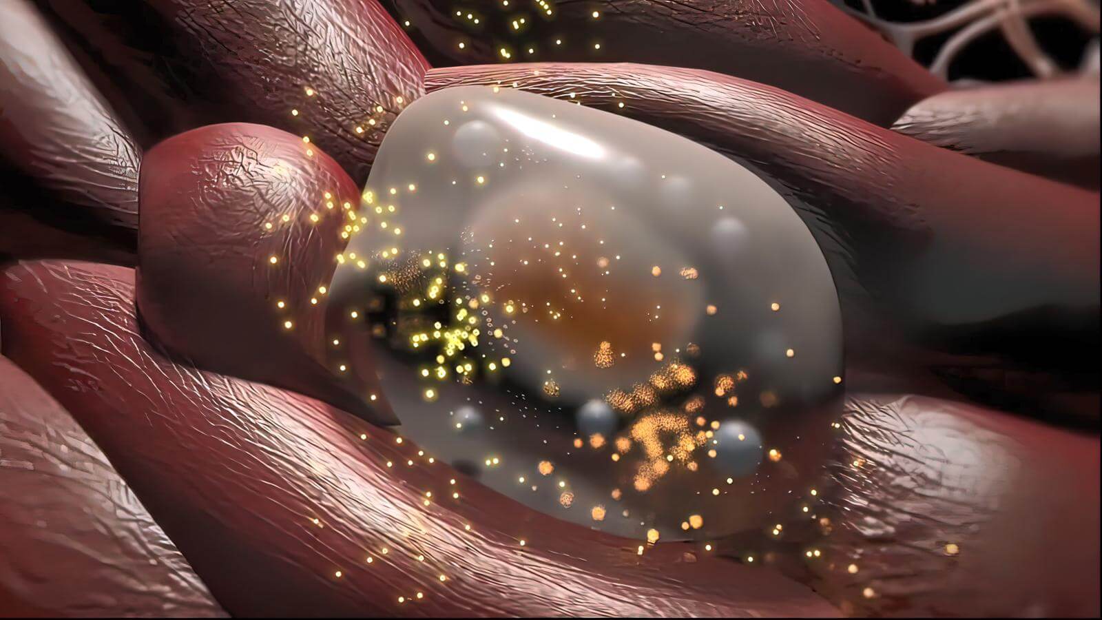 Complication of COPD