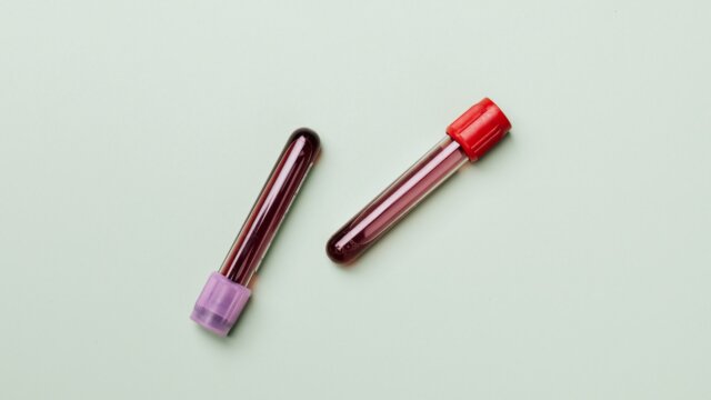 Understanding Abnormal Full Blood Count: Causes & Management