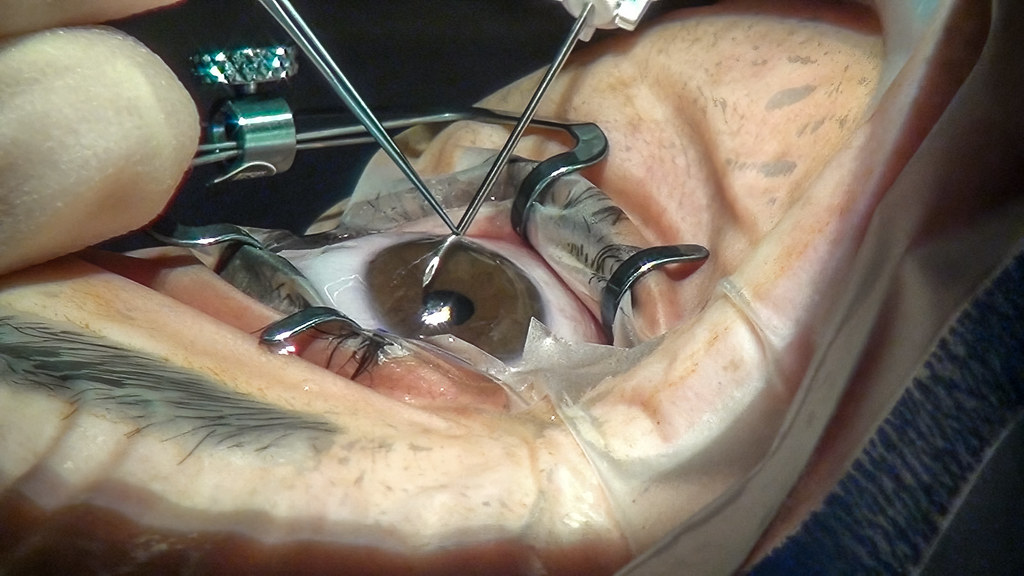 What to Expect after Glaucoma Surgery? A Comprehensive Guide