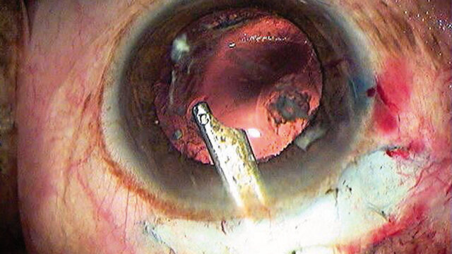 Understanding the Difference Between Cataracts and Glaucoma: Causes, Symptoms, and Treatment Options
