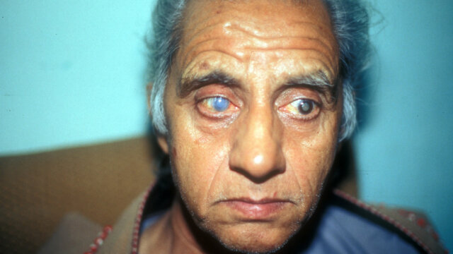 Understanding Eye Floaters and Glaucoma: Clearing Up the Confusion