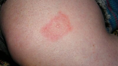 Unraveling the Connection: Lyme Disease and Arthritis Explained