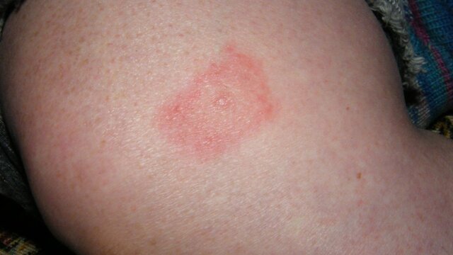 Unraveling the Connection: Lyme Disease and Arthritis Explained