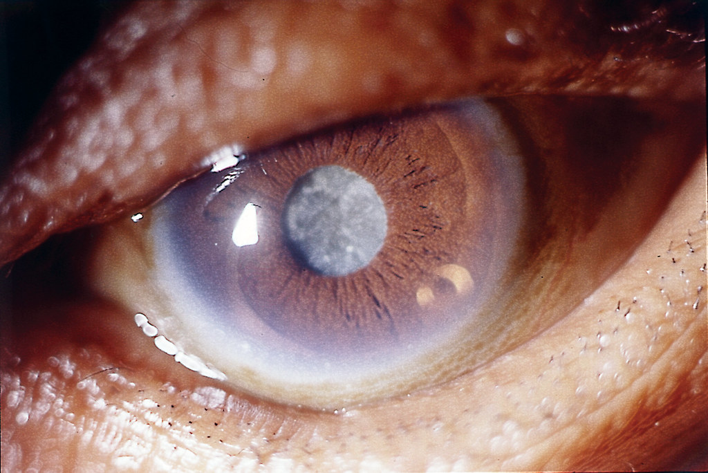 Understanding cataract