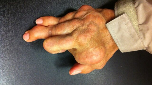 Comprehensive Guide to Diagnosing and Managing Rheumatoid Arthritis: A Practical Resource for Improved Quality of Life