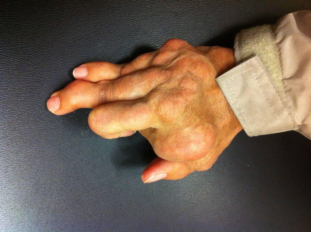 Diagnosing and Managing Rheumatoid Arthritis