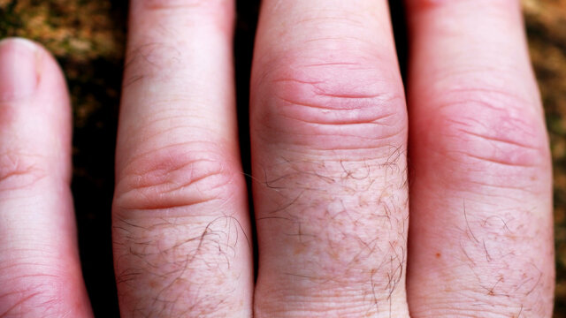 Understanding Rheumatoid Arthritis: Symptoms, Causes, and Effects on the Body