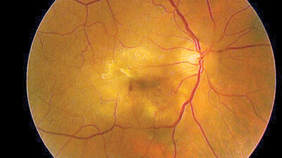 Understanding the Differences: Wet vs Dry Macular Degeneration – What You Need to Know