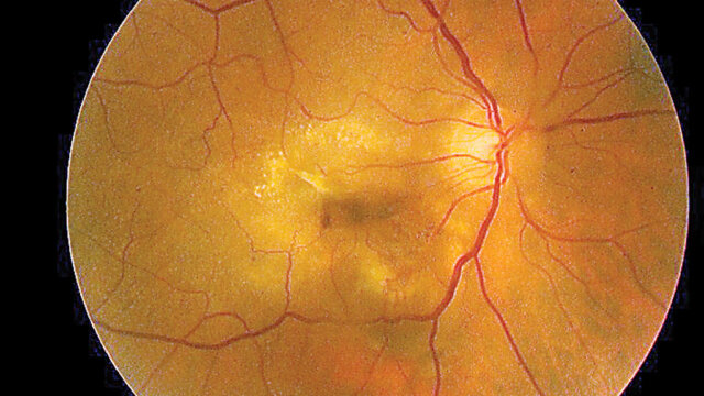 Understanding the Differences: Wet vs Dry Macular Degeneration – What You Need to Know