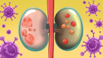 Understanding Bladder Cancer: Signs and Treatment