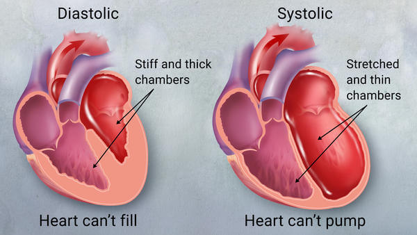 Diastolic and systolic heart failure