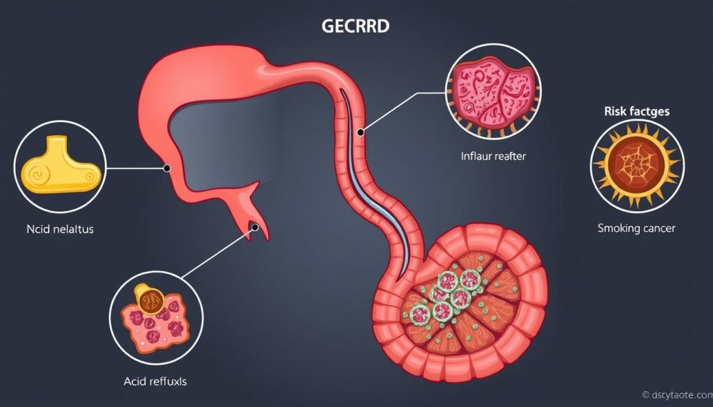 GERD and Esophageal Cancer