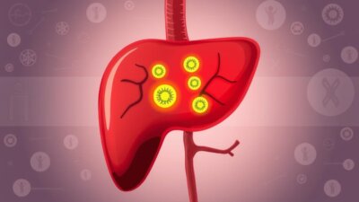 Understanding Liver Cancer: Causes and Treatments