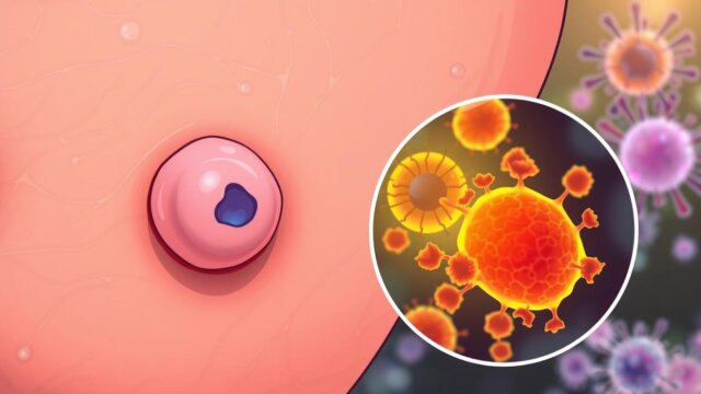 Understanding Merkel Cell Cancer: Symptoms and Treatment